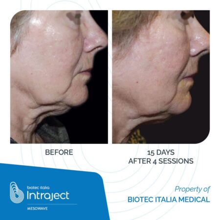 INTRAJECT_Mesowave_Before-After_01